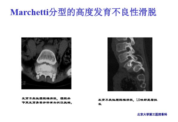 【PPT】腰椎滑脱的临床分型与影像学诊断