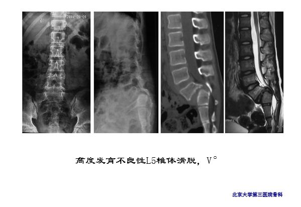 【PPT】腰椎滑脱的临床分型与影像学诊断