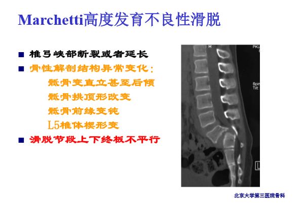 【PPT】腰椎滑脱的临床分型与影像学诊断