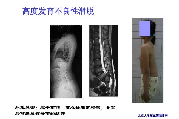【PPT】腰椎滑脱的临床分型与影像学诊断