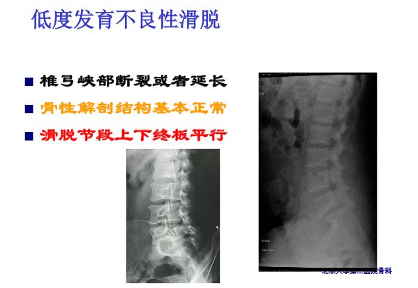 【PPT】腰椎滑脱的临床分型与影像学诊断