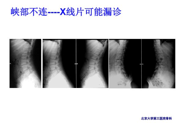 【PPT】腰椎滑脱的临床分型与影像学诊断