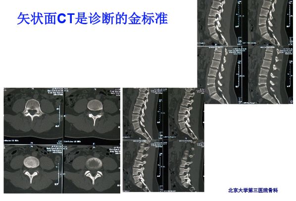 【PPT】腰椎滑脱的临床分型与影像学诊断