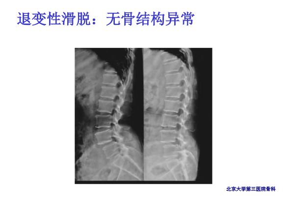 【PPT】腰椎滑脱的临床分型与影像学诊断