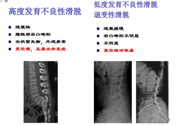 【PPT】腰椎滑脱的临床分型与影像学诊断