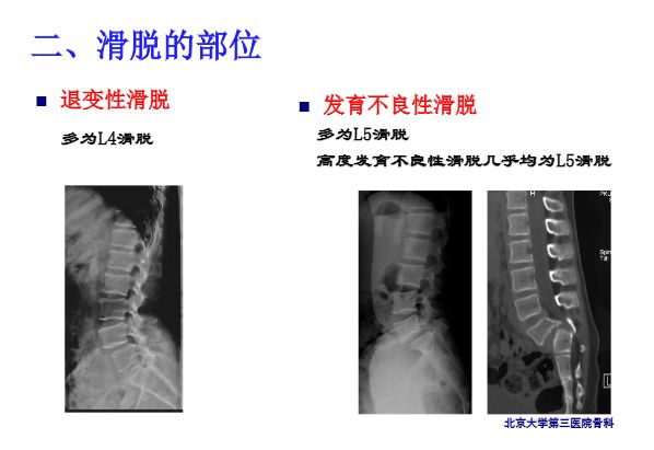 【PPT】腰椎滑脱的临床分型与影像学诊断