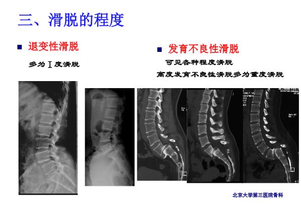 【PPT】腰椎滑脱的临床分型与影像学诊断