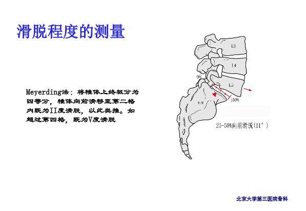 【PPT】腰椎滑脱的临床分型与影像学诊断