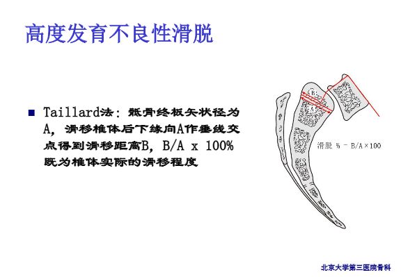 【PPT】腰椎滑脱的临床分型与影像学诊断