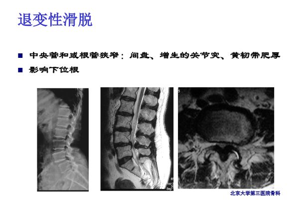 【PPT】腰椎滑脱的临床分型与影像学诊断