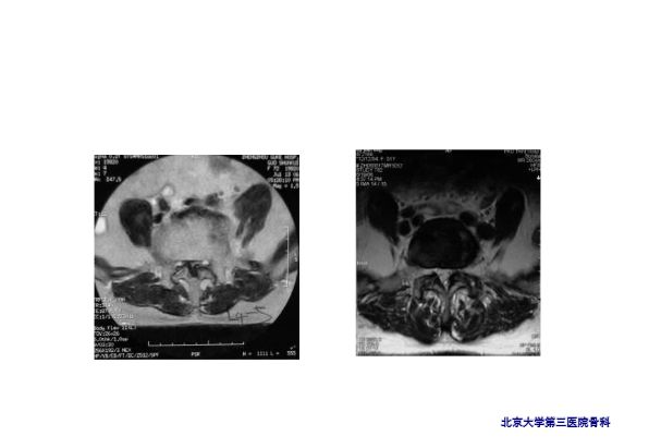 【PPT】腰椎滑脱的临床分型与影像学诊断