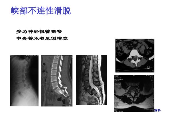 【PPT】腰椎滑脱的临床分型与影像学诊断