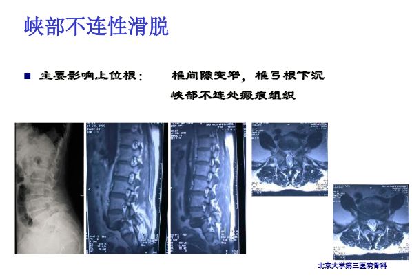 【PPT】腰椎滑脱的临床分型与影像学诊断