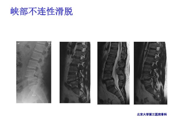 【PPT】腰椎滑脱的临床分型与影像学诊断