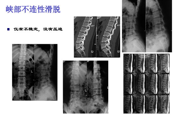 【PPT】腰椎滑脱的临床分型与影像学诊断