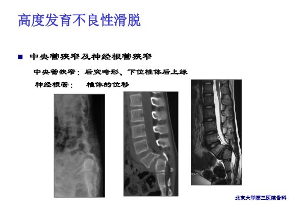 【PPT】腰椎滑脱的临床分型与影像学诊断