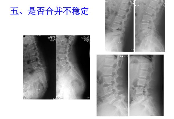 【PPT】腰椎滑脱的临床分型与影像学诊断