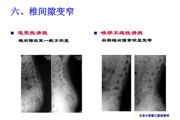 【PPT】腰椎滑脱的临床分型与影像学诊断