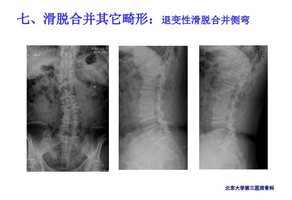 【PPT】腰椎滑脱的临床分型与影像学诊断