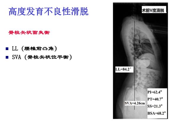 【PPT】腰椎滑脱的临床分型与影像学诊断