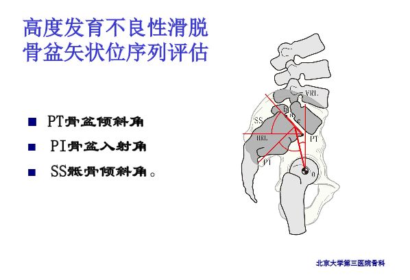 【PPT】腰椎滑脱的临床分型与影像学诊断