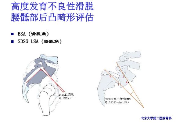 【PPT】腰椎滑脱的临床分型与影像学诊断