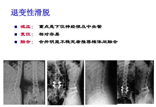 【PPT】腰椎滑脱的临床分型与影像学诊断