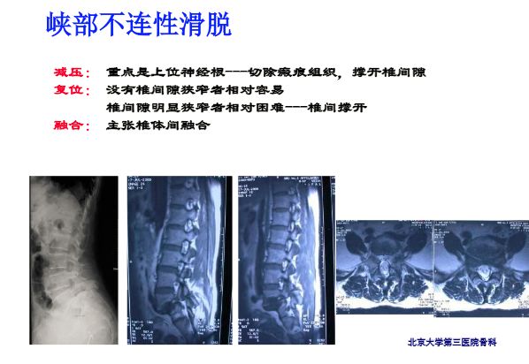 【PPT】腰椎滑脱的临床分型与影像学诊断