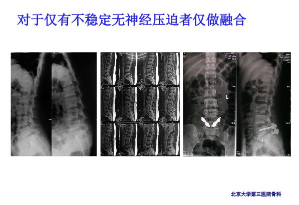 【PPT】腰椎滑脱的临床分型与影像学诊断