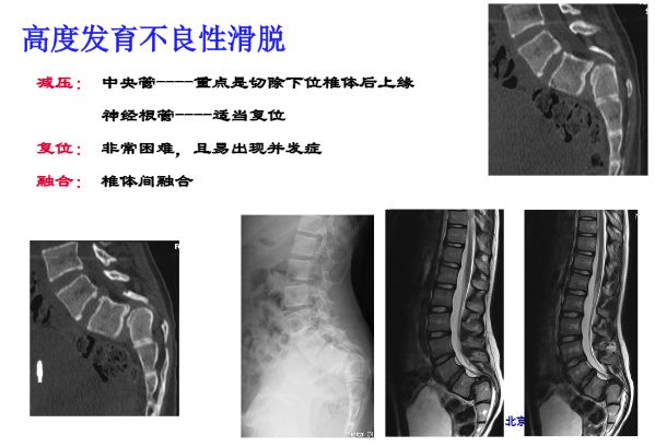 【PPT】腰椎滑脱的临床分型与影像学诊断