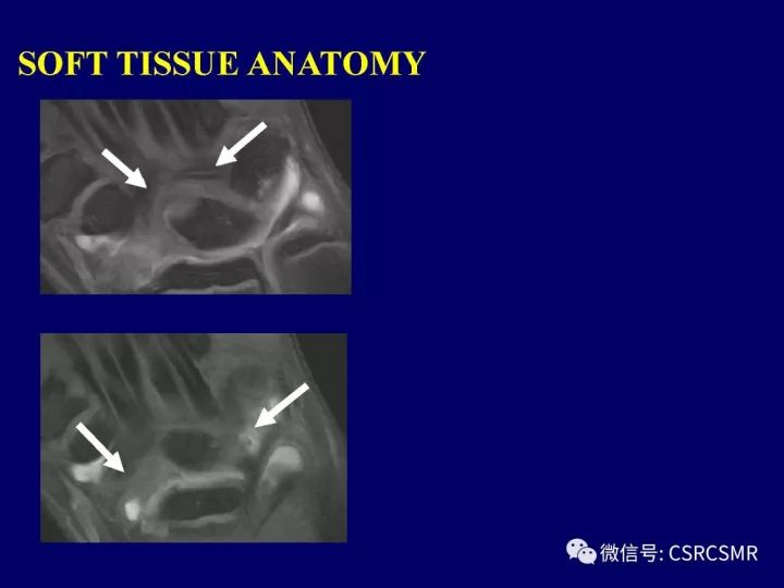 【PPT】腕关节韧带损伤的病理及影像学表现