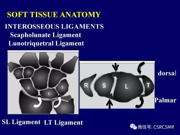 【PPT】腕关节韧带损伤的病理及影像学表现