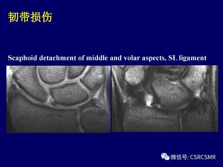 【PPT】腕关节韧带损伤的病理及影像学表现