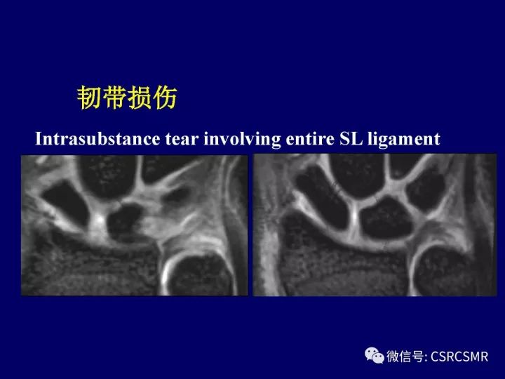 【PPT】腕关节韧带损伤的病理及影像学表现