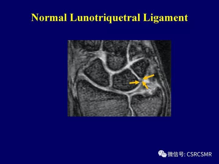 【PPT】腕关节韧带损伤的病理及影像学表现
