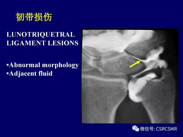 【PPT】腕关节韧带损伤的病理及影像学表现