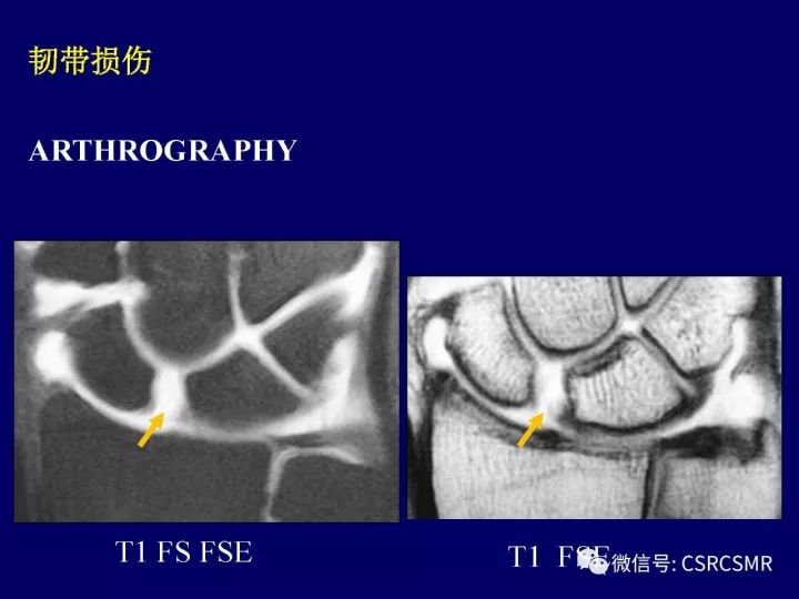 【PPT】腕关节韧带损伤的病理及影像学表现