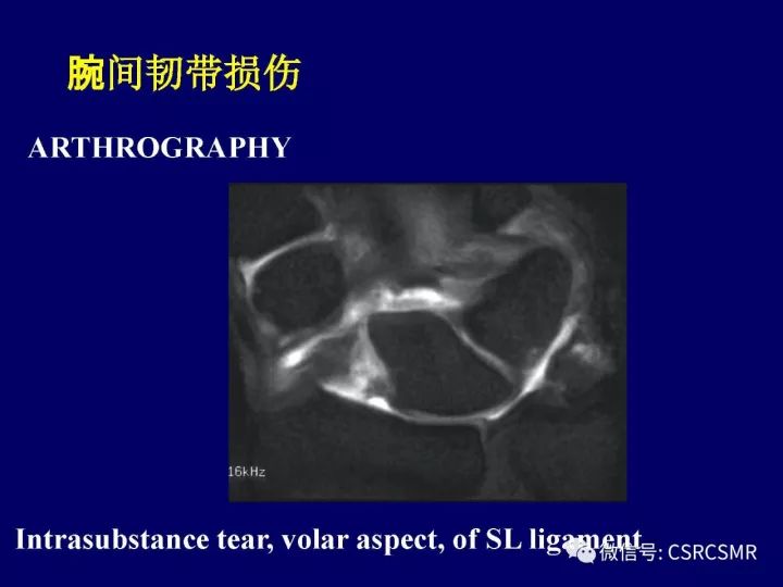 【PPT】腕关节韧带损伤的病理及影像学表现