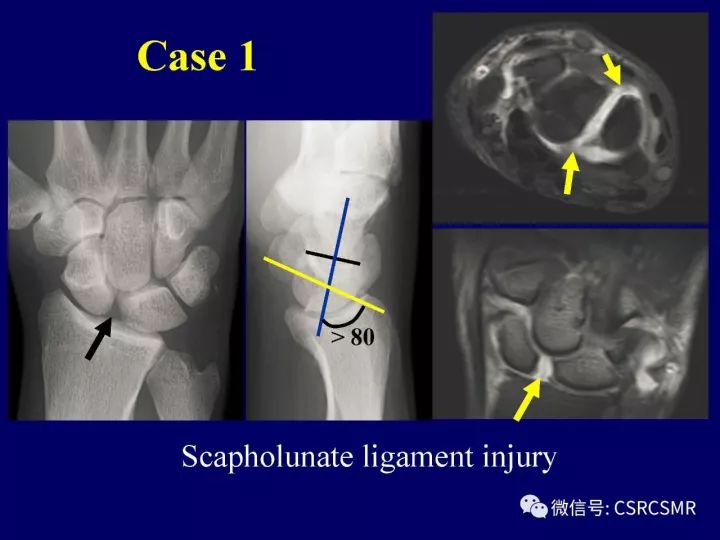 【PPT】腕关节韧带损伤的病理及影像学表现