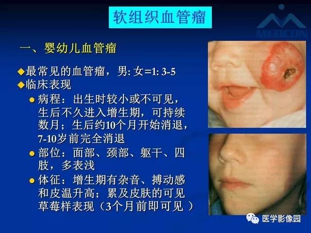 【PPT】软组织血管瘤和血管畸形的分类及MRI诊断