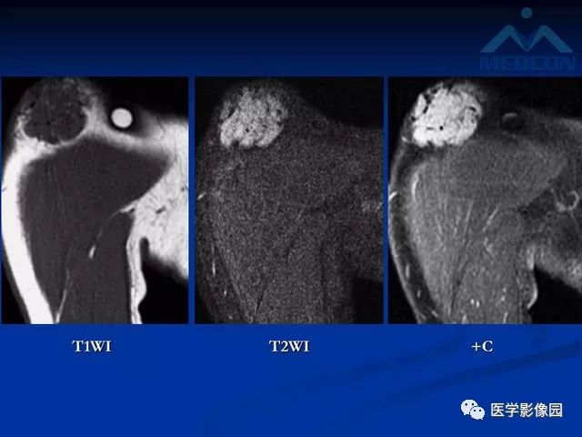 【PPT】软组织血管瘤和血管畸形的分类及MRI诊断