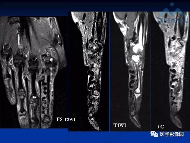 【PPT】软组织血管瘤和血管畸形的分类及MRI诊断