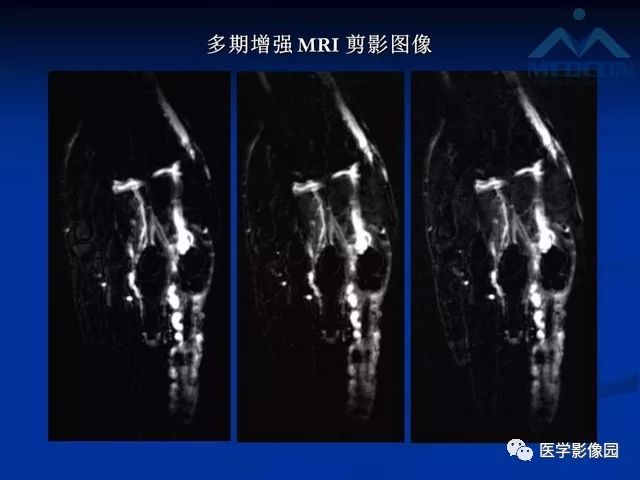 【PPT】软组织血管瘤和血管畸形的分类及MRI诊断