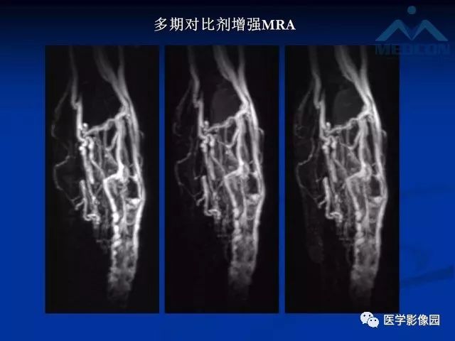 【PPT】软组织血管瘤和血管畸形的分类及MRI诊断