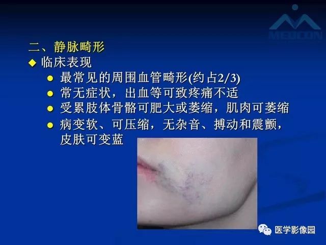 【PPT】软组织血管瘤和血管畸形的分类及MRI诊断