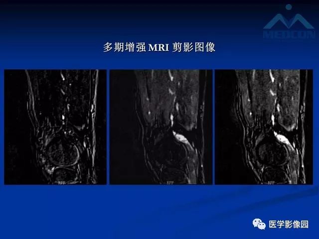 【PPT】软组织血管瘤和血管畸形的分类及MRI诊断