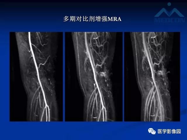 【PPT】软组织血管瘤和血管畸形的分类及MRI诊断