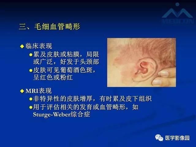 【PPT】软组织血管瘤和血管畸形的分类及MRI诊断