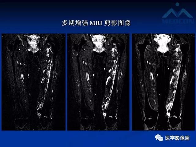 【PPT】软组织血管瘤和血管畸形的分类及MRI诊断