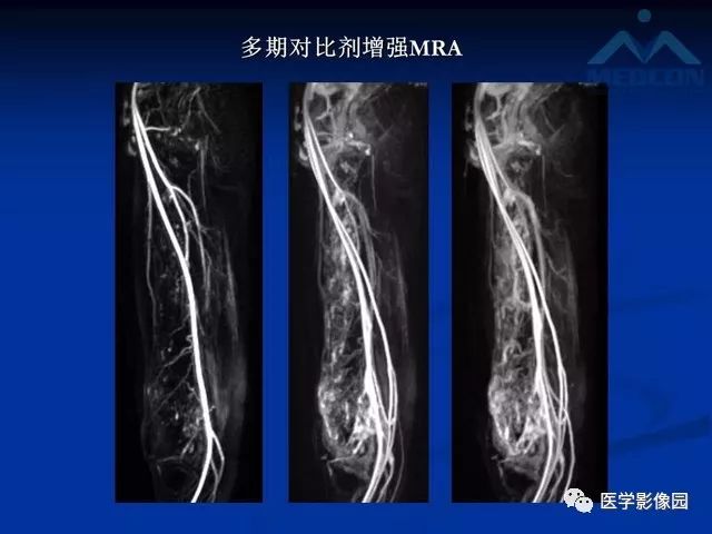 【PPT】软组织血管瘤和血管畸形的分类及MRI诊断